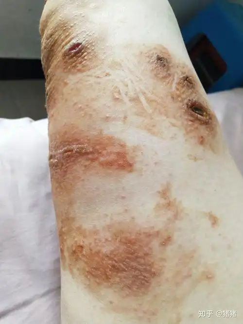 被海蜇蛰伤已经4个多月了这几天又复发了有经验的探讨一下怎么才能好