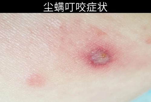 螨虫叮咬后的症状图人身上被螨虫咬的图片螨虫怎么去除