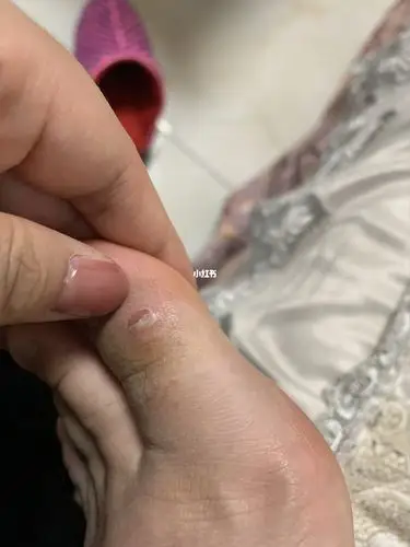 今天是生完宝宝后,因为工作需要,第一次穿高跟鞋,直接把脚磨破了,别看