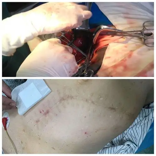 写美篇消融治疗肿瘤与手术治疗相比的优势: 1,外科手术操作创面大