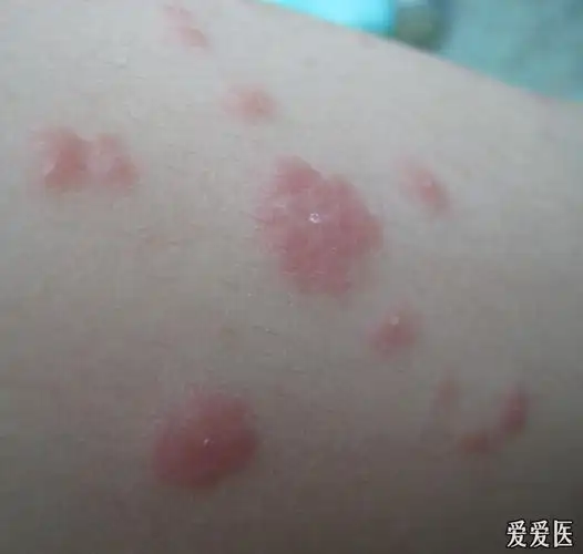 螨虫皮炎治疗前后,您来看一看 - 皮肤及性传播疾病讨论版 - 爱爱医