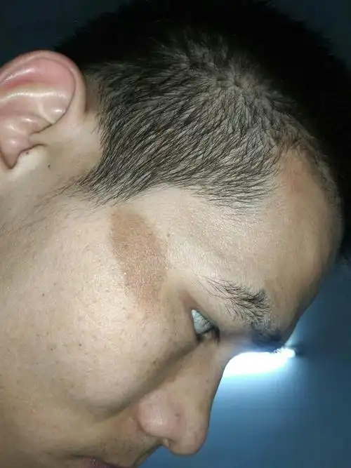 都4个月了,还能消掉吗疤痕色素沉着.