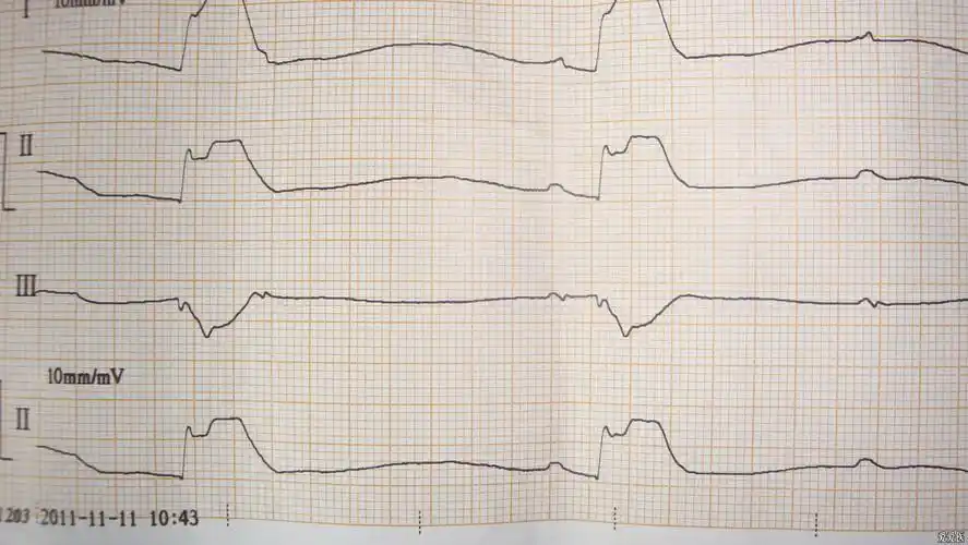 和常规不一样的死亡心电图,怎么下诊断?