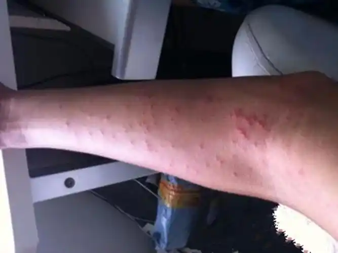 得了风疹的症状图片