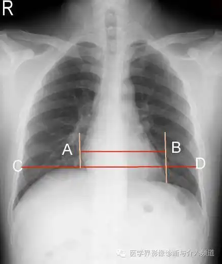 全面解密:正确的,正常的,胸部正位片!