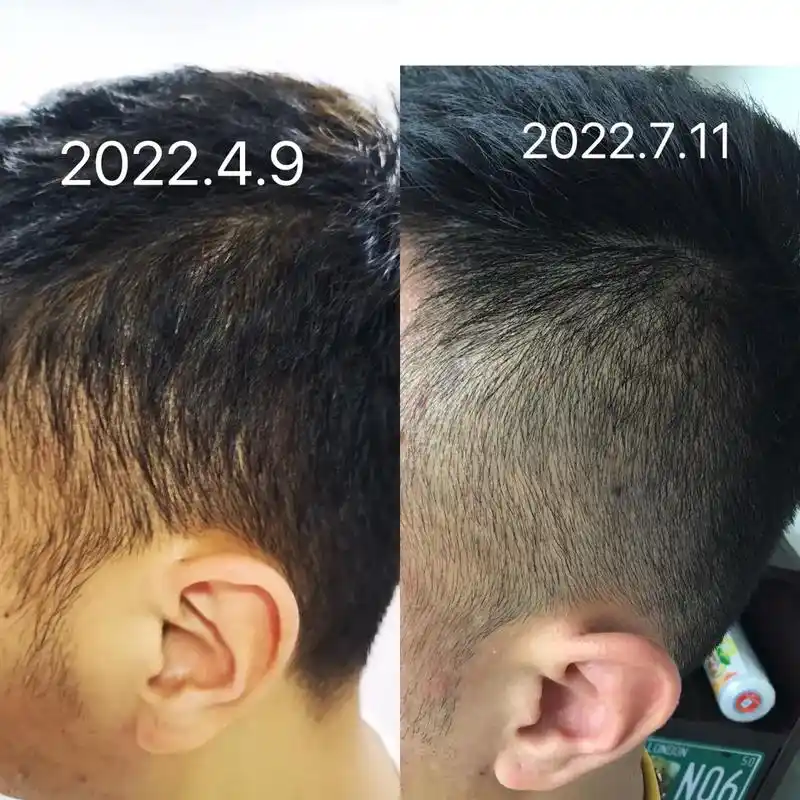 图片放大毛囊清晰干净油脂少了二侧发量增多头发光泽度好头发活力十足