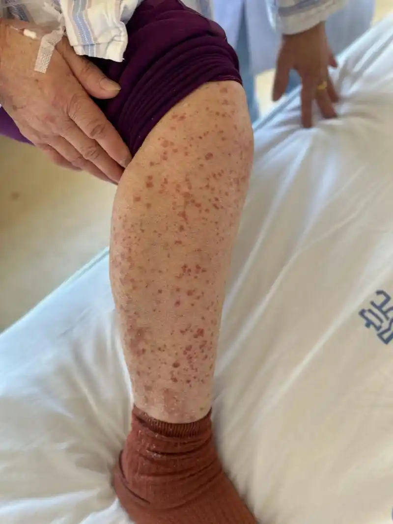 这是紫癜,也就是皮下出血的意思,多见于下肢,躯体和上肢也可以出现