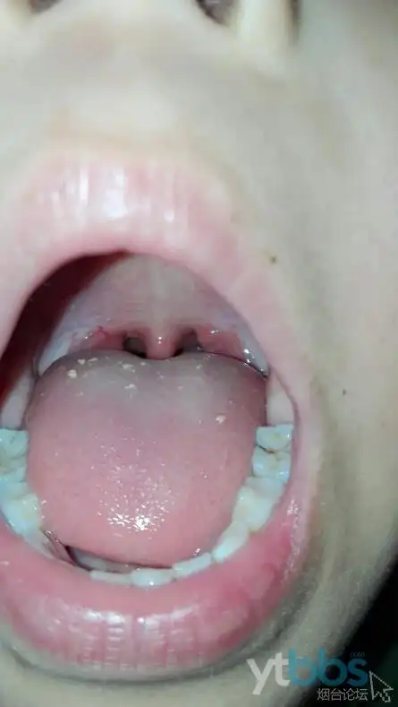 小儿推拿——感冒流涕,咽喉肿痛,低烧