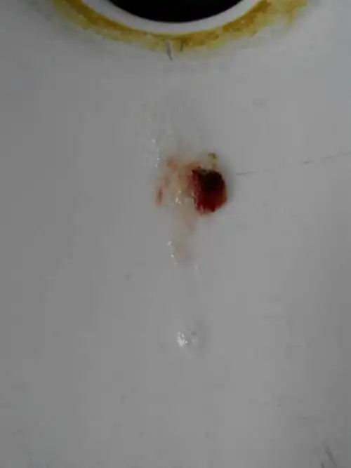 今早刷牙仰淑时有点咳嗽,把水吐出来后发现有黑色血块,这个是后面咳