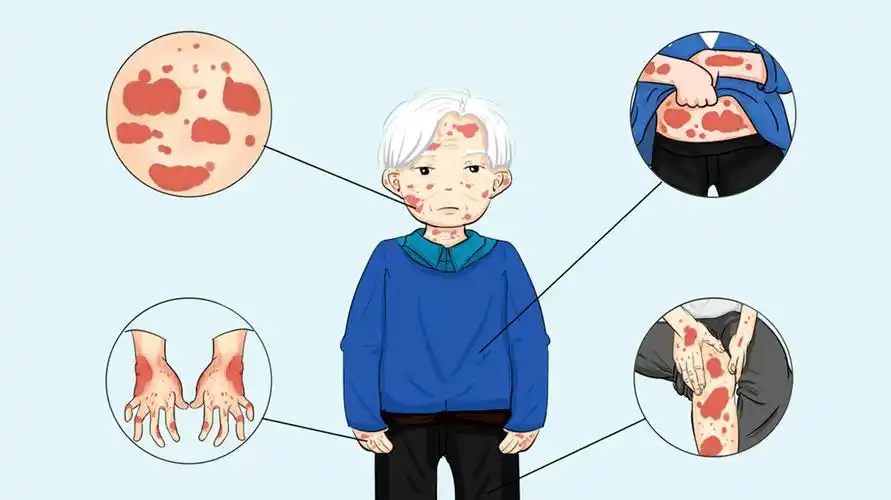 红斑鳞屑瘙痒是银屑病即日起川蜀名医联合坐诊名额有限速约