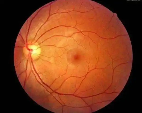 正常眼底