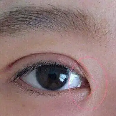 什么是内眦赘皮?