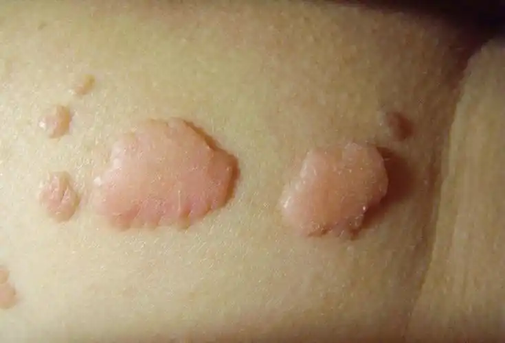 假尖锐湿疣白醋测试图片_有来医生