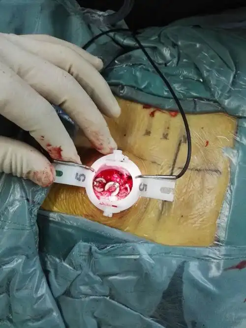 腰椎管狭窄症 写美篇 患者女性,81岁