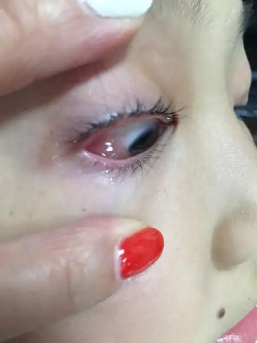 昨天小孩子眼睛突然这样了 也不疼求哪位知道的医生朋友或是懂得告诉