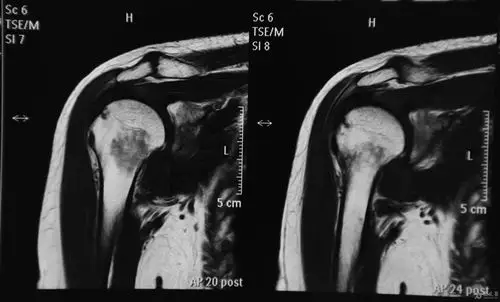 右肱骨颈部mri低信号区的形成原因请教?