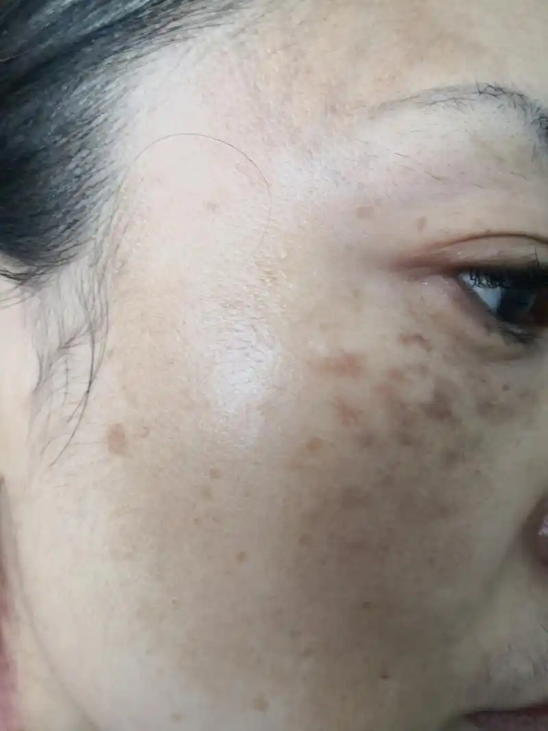 额头面颊弥漫性黄褐色斑片.