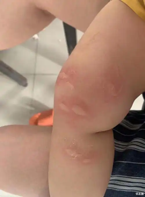 恶毒的蚊子,把我家宝咬了这么多个大包