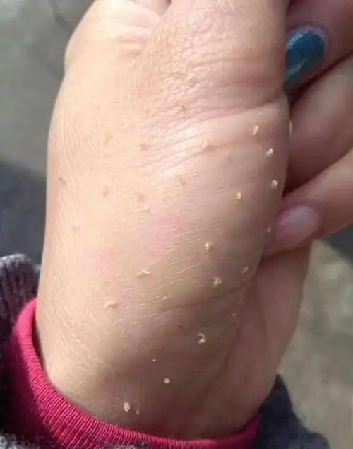 你还在用手挤黑头?那一定是不知道鸡蛋 它能彻底去黑头!