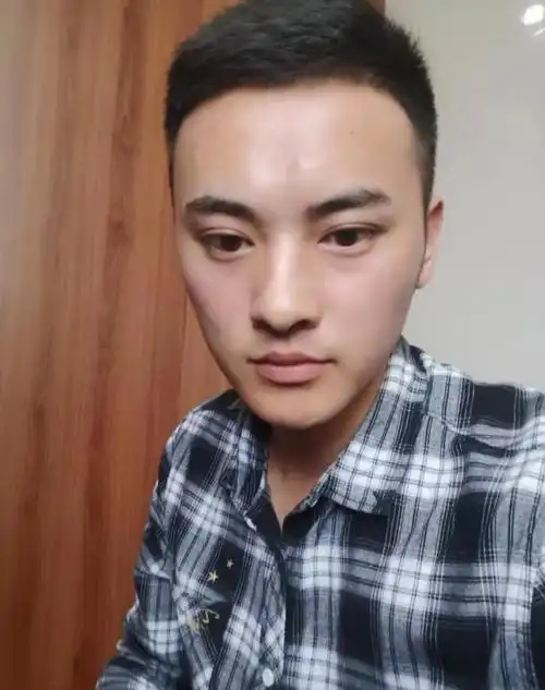 25岁小伙植发2800单位,光发际线设计1小时半,术后6个月