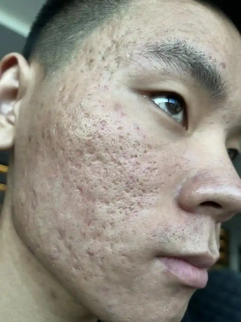 上热门 #问题性皮肤管理 #打造素颜 #痘坑 #告别肌肤问 - 抖音