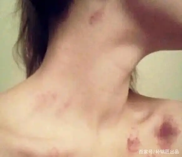 吻痕怎么快速消除