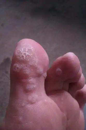 鸡眼图片初期症状 鸡眼早期症状图片