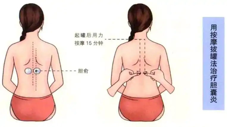 胆囊炎用拔罐疗法来调养效果好配合这吃这些更佳