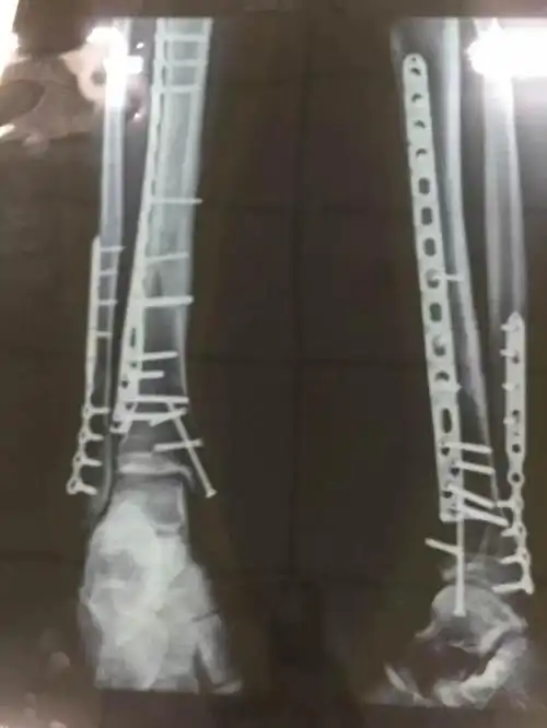 "雪上公主"晒图"数不清的钢钉" 网友震惊泪目!(组图)