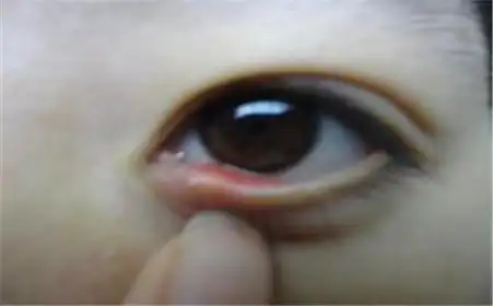 泪腺肿混合瘤症状_泪腺混合瘤_健康一线