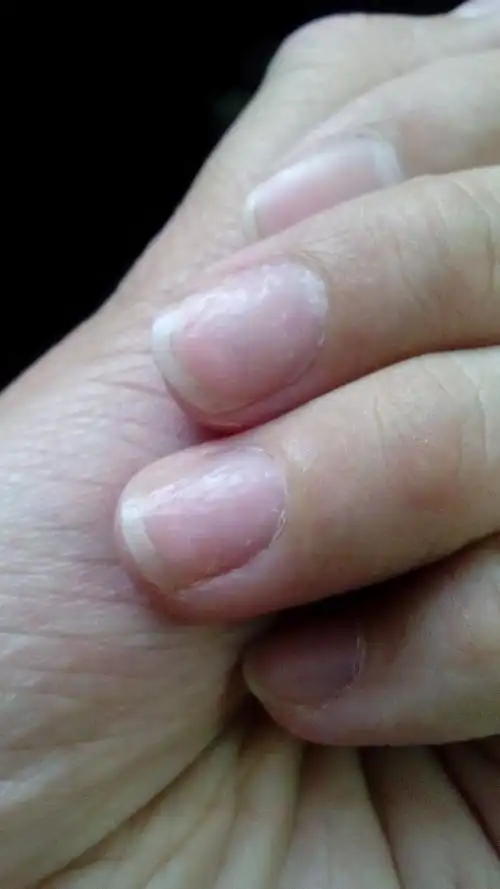 我的指甲盖上坑坑洼洼的,怎么回事啊?