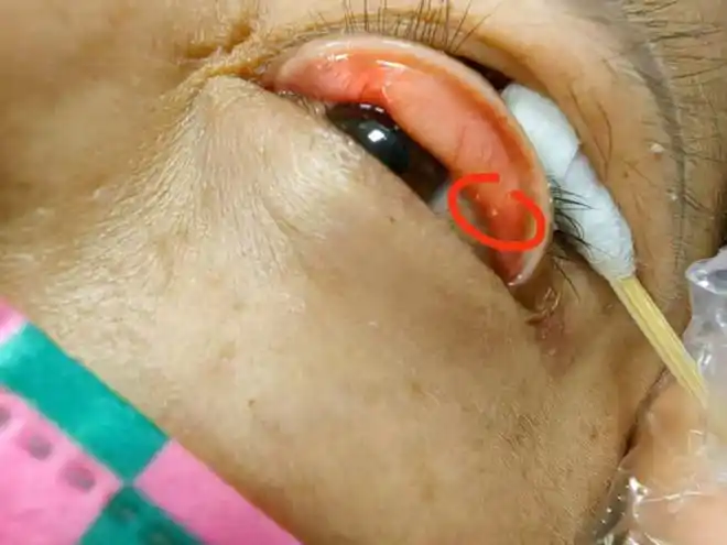 科普眼睛异物感那你可能遇上结膜结石了