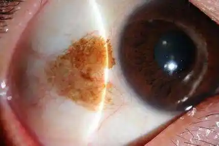 结膜色素痣及黑色素瘤 - 好大夫在线