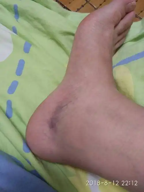 脚上莫名出现一块淤青,手按不疼不痒,是什么情况?如下图