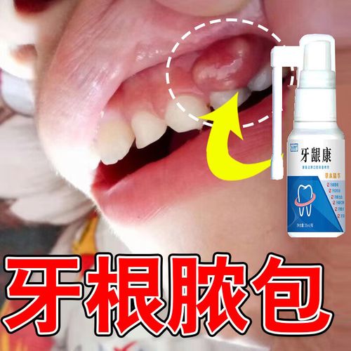 牙龈脓肿牙龈肿包牙根瘘管囊肿长脓包鼓包反复牙齿根尖周炎辅助喷剂