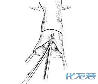 4,设计切口:用一把止血钳夹住包皮系带处,以提起包皮.
