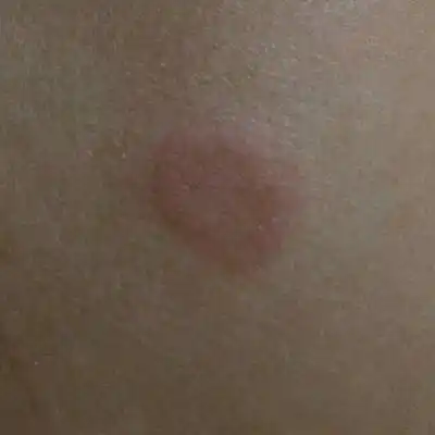 六个月的宝宝大腿旁长的拇指大的红坨是什麼