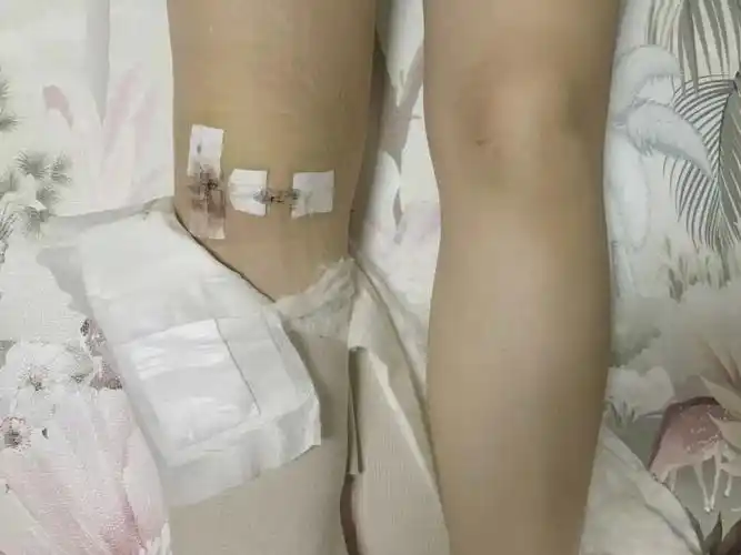 半月板手术1个月术后恢复详情_疤痕_伤口愈合_出水_半月板损伤_医疗