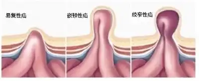 腹股沟疝是什么教授话你知