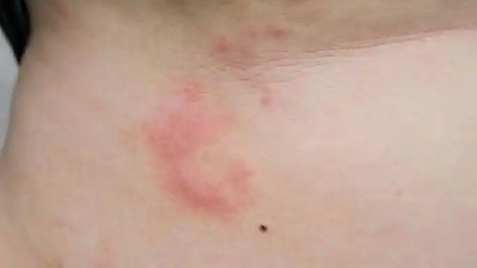 丘疹性荨麻疹的病因有哪些?