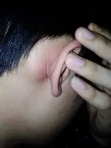 耳前淋巴结肿大