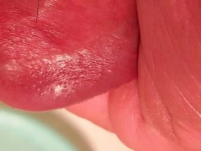 这是尖锐湿疣吗?冠状沟小丘疹五个月了,不痛不痒的