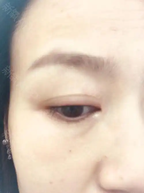 半永久美瞳线项目术后第1天