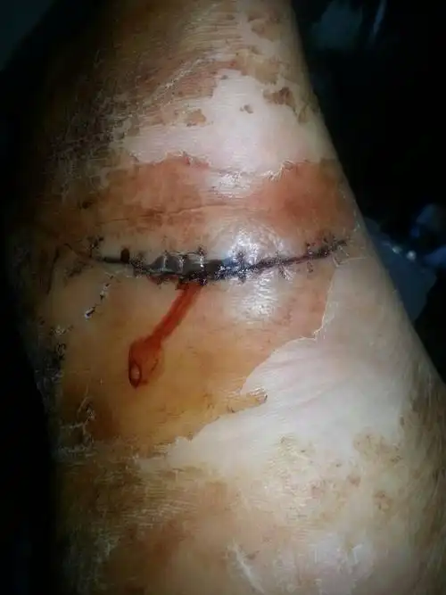 脚底板缝针拆线伤口整样才算正常?