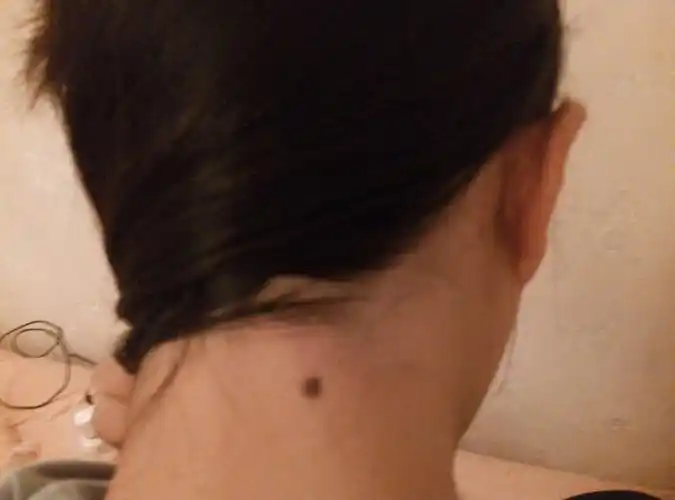 脖子后面有痦子代表什么?