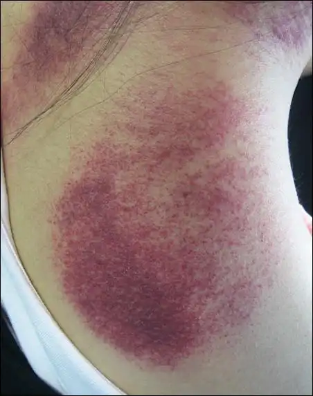 刮痧能解决脖子痛