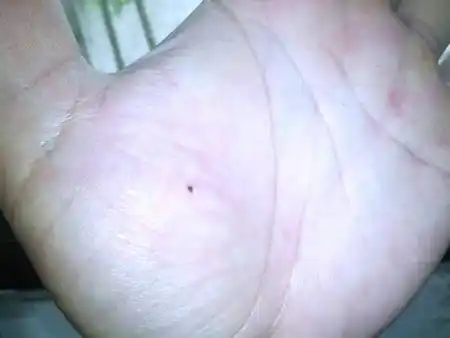 问:手掌有颗痣,有何见解?