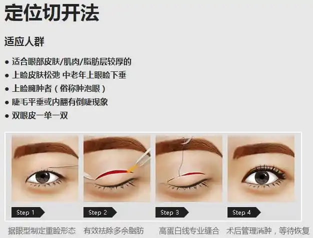 真实案例对比:精细切开双眼皮优势1,具有可恢复性2,手术时间短3,适合