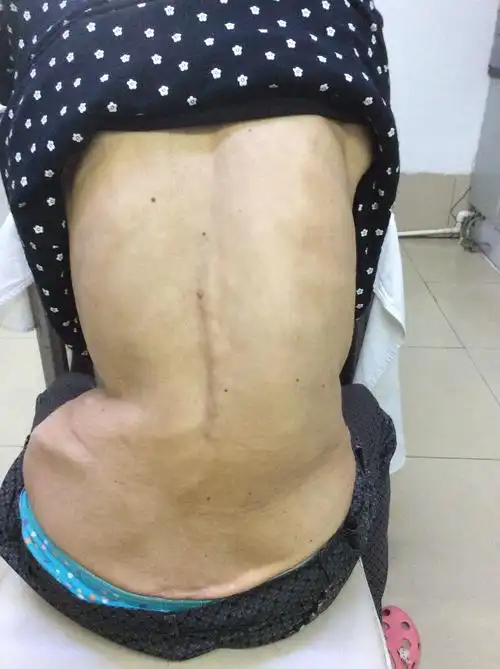 上海强直性脊柱炎的治疗方法有哪些_脊柱性风湿的治疗方法_生物制剂