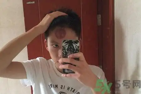 首页 养生 中医额头上是可以拔火罐的,长期的额头拔罐可以起到活血